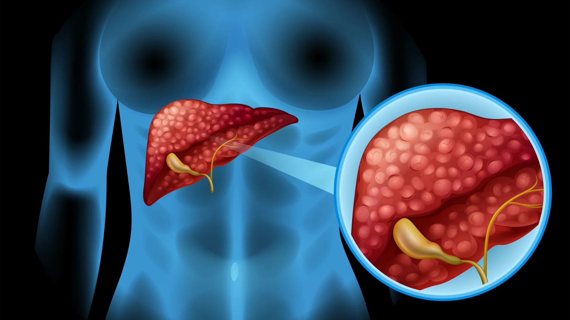 Liver Cirrhosis